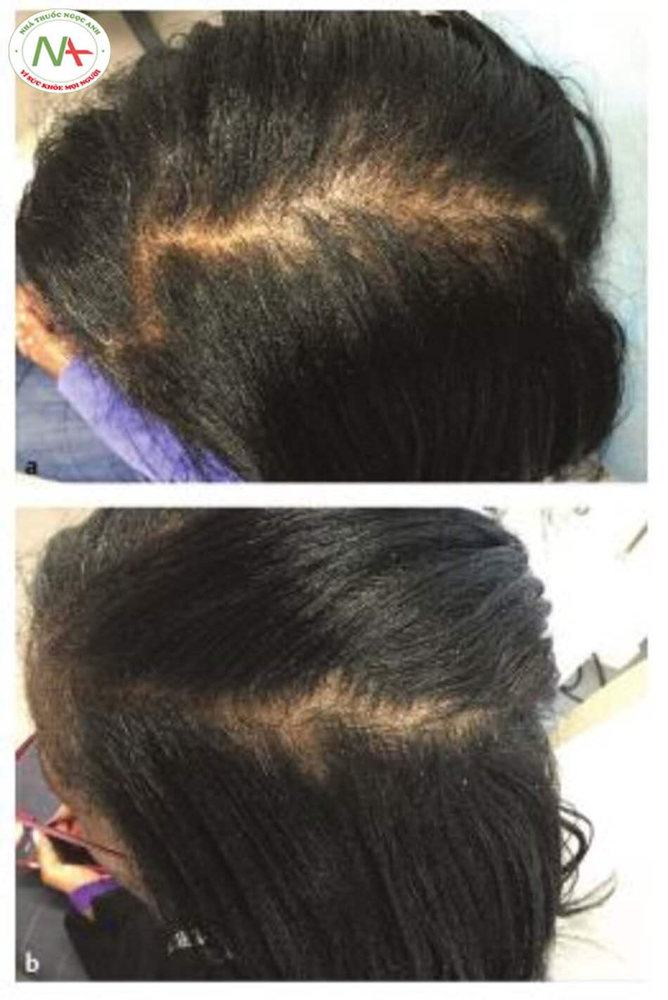 Hình 9.5 Rụng tóc nội tiết (a) Trước và (b) sau điều trị bởi microneedling và PRP. (© Cary Coldenberg. Used with permission.)