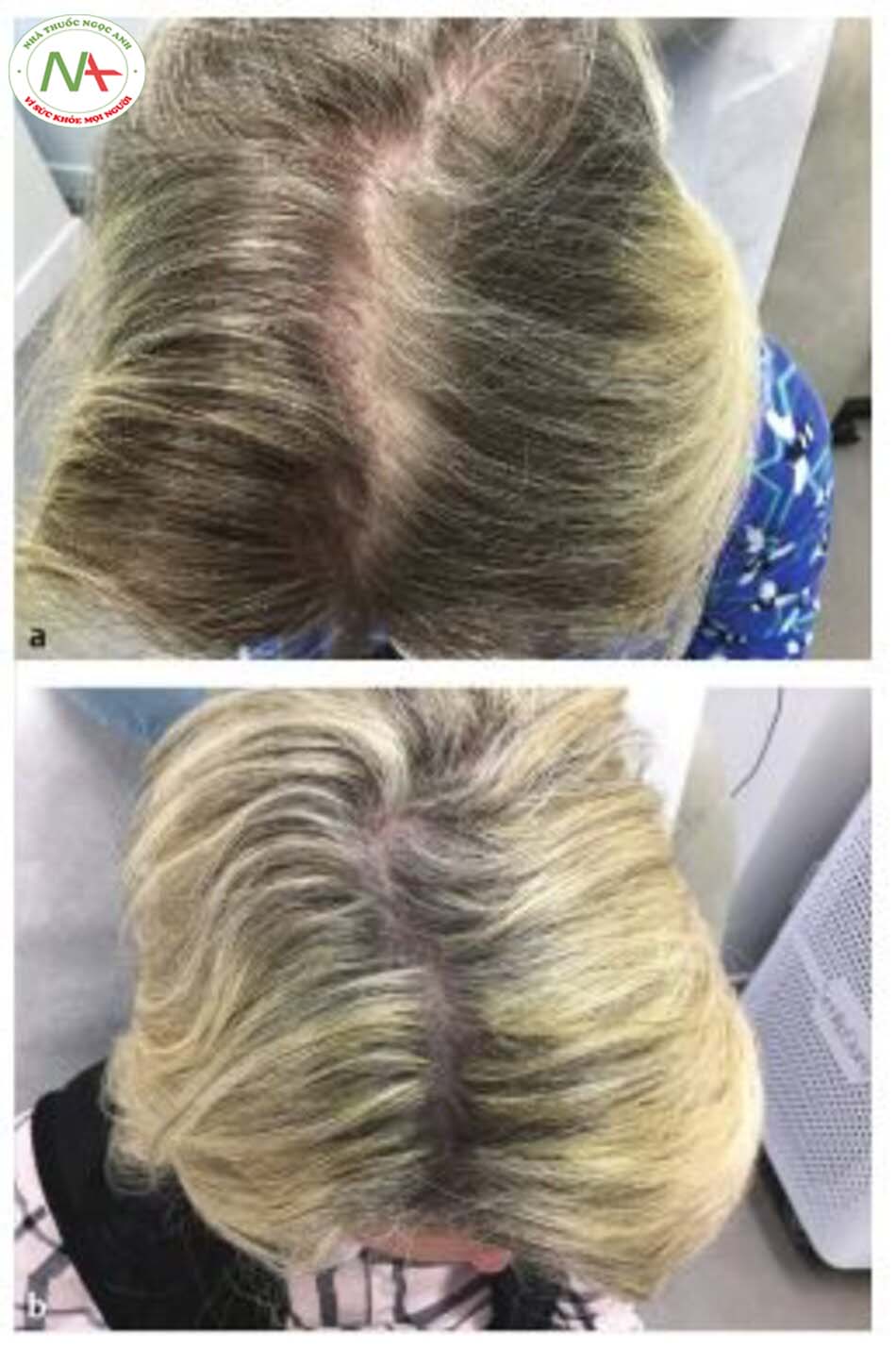 Hình 9.6 Rụng tóc nội tiết (a) Trước và (b) sau điều trị bằng microneedling và PRP. (© Cary Coldenberg. Used with permission.)