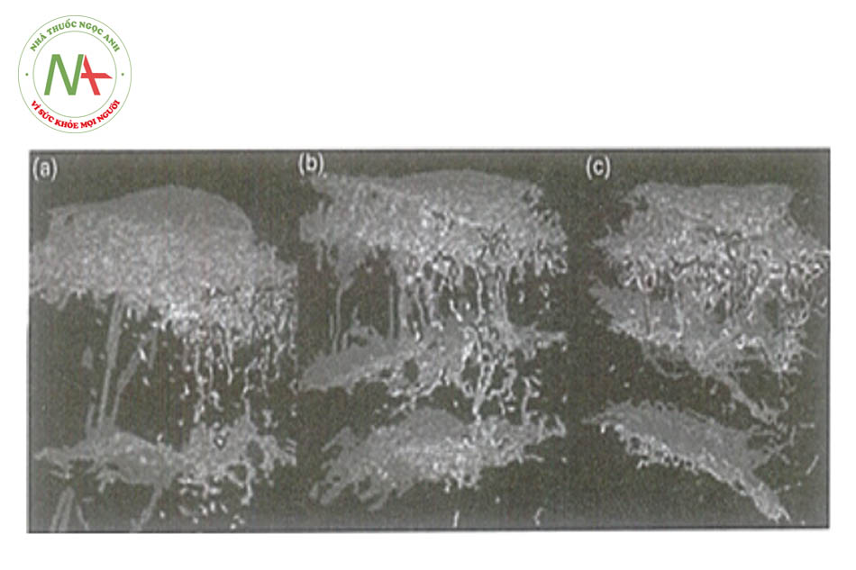 Hình 19.2. Ảnh chụp 3D cấu trúc mô liên kết dưới da (a) Phụ nữ bị cellulite, (b) Phụ nữ bình thường, (c) Nam giới