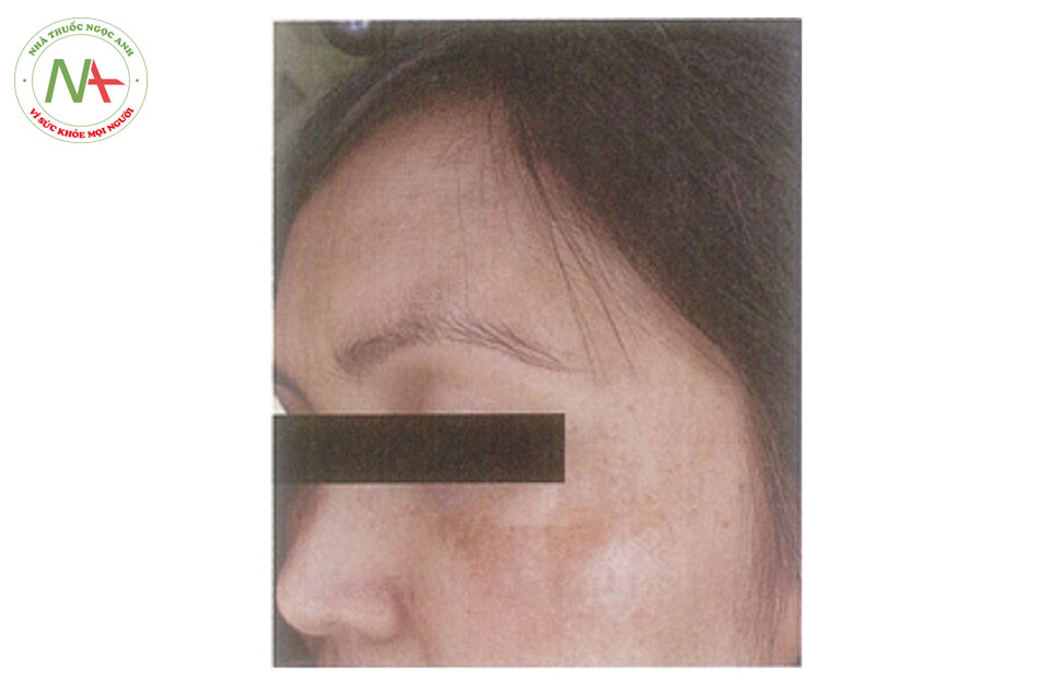 Hình 13.2. Nám biểu hiện bằng các vết và mỏng sậm mờ trên vùng mặt