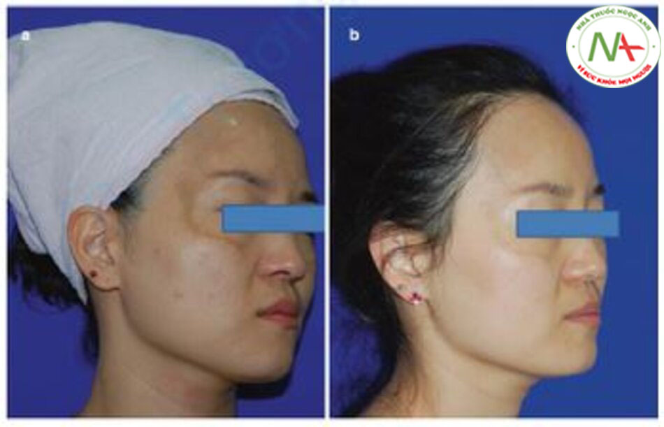 Hình 12.16 Sự cải thiện nám da có thể được nhìn thấy sau khi điều trị bằng laser toning 10 lần. Trái: trước khi điều trị, phải: sau khi điều trị 