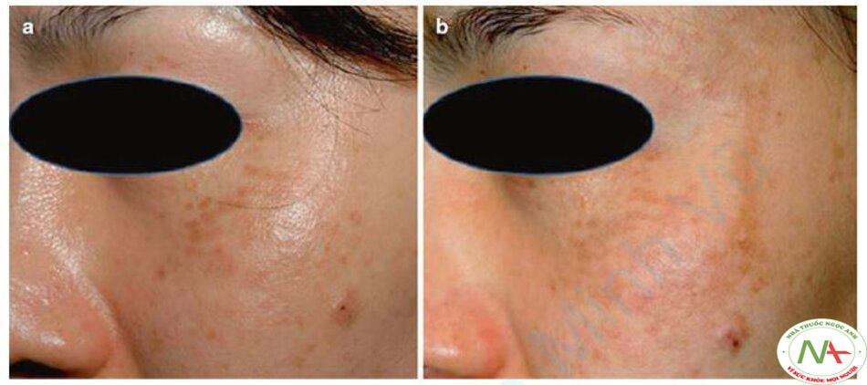 Hình 12.2 (a) Hình ảnh lâm sàng của ABNOM trước khi điều trị bằng laser. Các mảng nhỏ, màu xanh- nâu, rời rạc ở hai bên má và vùng quanh hốc mắt. (b) Tổn thương nám mới phát triển ở vùng quanh mắt trái. Các mảng hợp nhất màu nâu hơi bất thường được ghi nhận.