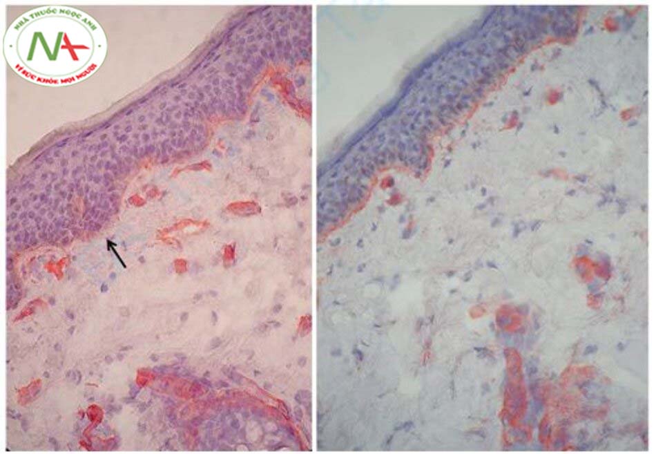 Hình 12.7 Hóa mô miễn dịch với kháng thể với collagen loại IV cho thấy sự phá vỡ (chỉ mũi tên) của màng đáy ở da nám (a), toàn vẹn của màng đáy ở da xung quanh của cùng một bệnh nhân (b).