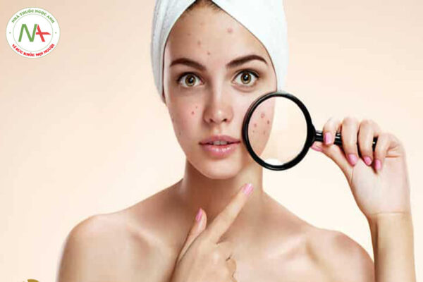 Tăng sắc tố da sau viêm là gì? Biểu hiện và cách điều trị