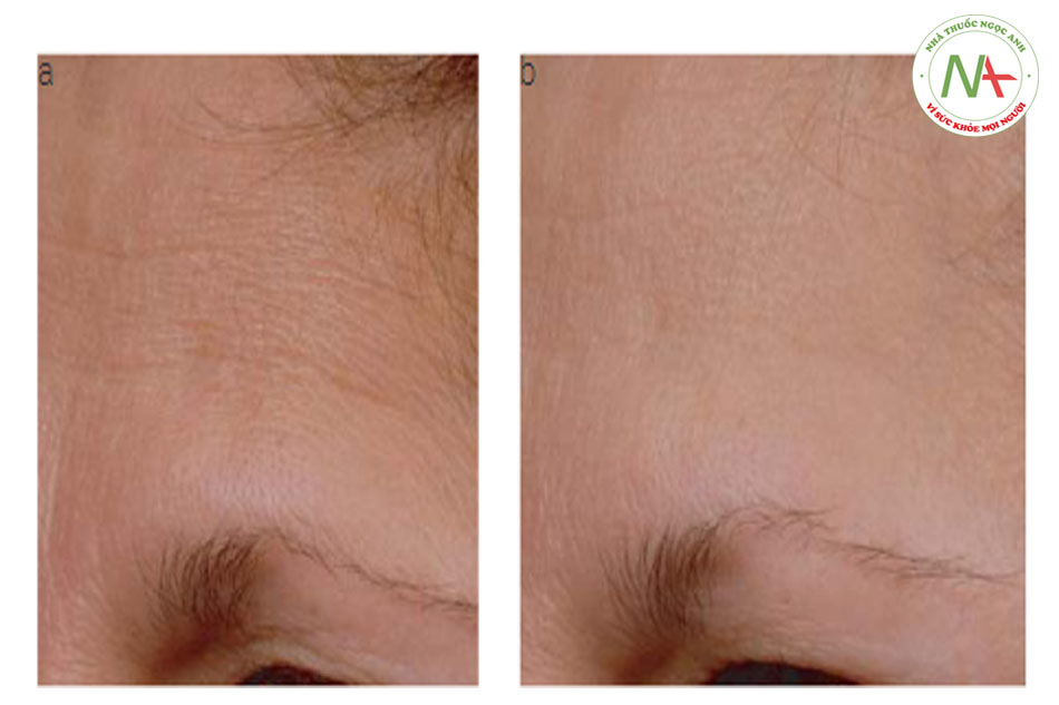 Hình 17.3 (a) và (b) Trước và sau khi sử dụng mỹ phẩm chứa 4% chiết xuất việt quất, 30% proxylane và 0,2% phytosphingosine trong 12 tuần. (SkinCeuticals A.G.E. Interrupter). Lưu ý cải thiện kết cấu da, rãnh nhăn và nếp nhăn trên trán. Source: Courtesy of SkinCeuticals.