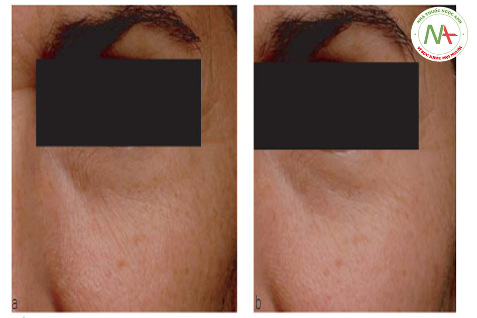 Hình 17.2 (a) và (b) Trước và sau khi sử dụng dược mỹ phẩm chứa 4% chiết xuất việt quất, 30% proxylane và 0,2% Phytosphingosine trong 12 tuần. (SkinCeuticals A.G.E. Interrupter). Lưu ý cải thiện nếp nhăn, sự lỏng lẻo, nhăn nheo và kết cấu da. Nguồn: Courtesy of SkinCeuticals. 