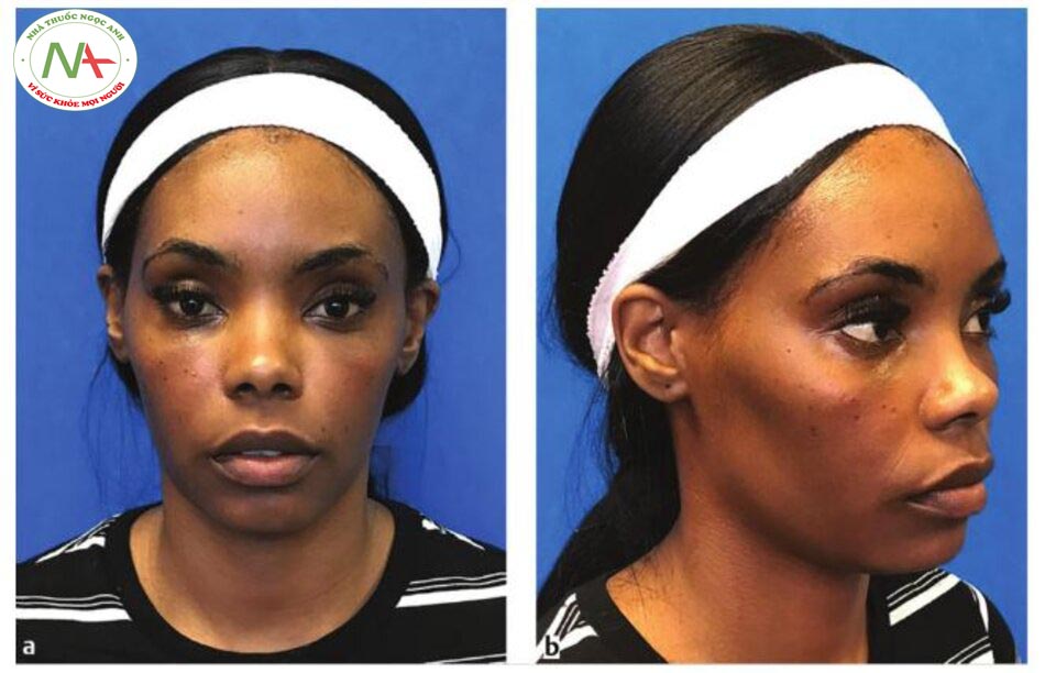 Chương 8Ứng dụng an toàn trên Da màu122Hình. 8.3 (a, b) Một bệnh nhân nữ 30 tuổi (loại da Fitzpatrick V) phàn nàn về chứng nám quanh hốc mắt và những vết rách đáng chú ý. Sau đó, cô đã trải qua hai quy trình khác nhau: (1) tiêm PRP vào các rãnh, và (2) lăn kim vi điểm với PRP để điều trị nám quanh hốc mắt và trẻ hóa da.