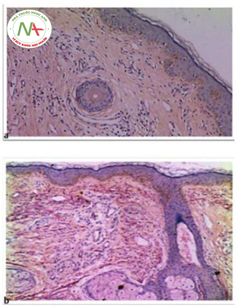 màu128Hình 8.5 (a) Hình ảnh mô học cho thấy một vết sẹo mụn trứng cá trước khi lăn kim và PRP với các sợi đàn hồi phân mảnh nhỏ (Orcein 9100). (b) Hình ảnh mô học cho thấy sẹo mụn sau điều trị các sợi đàn hồi tăng lên (Orcein 9100)