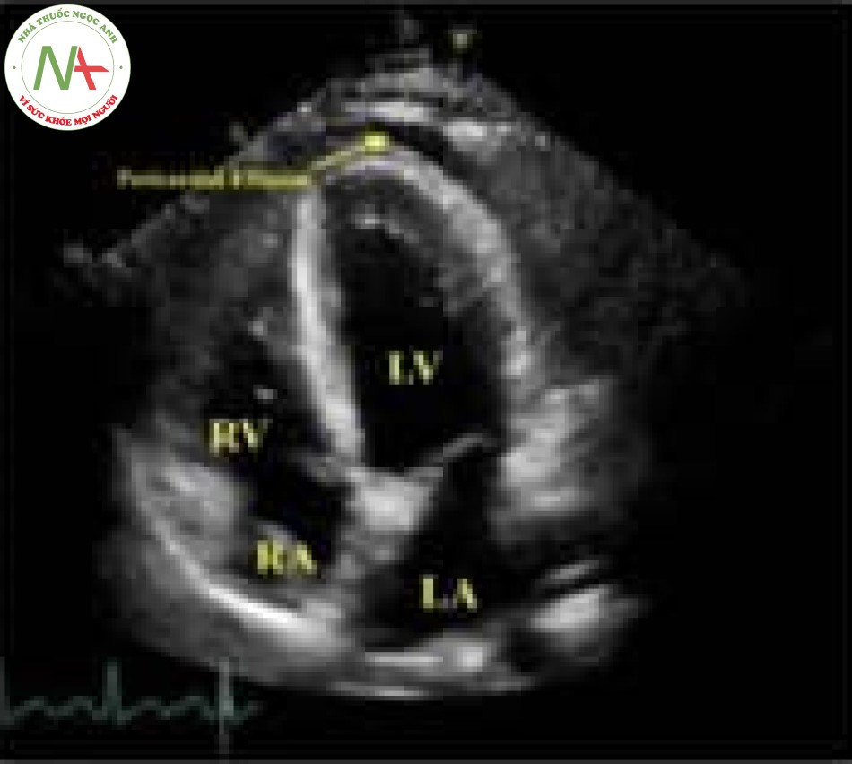 Hình 3 Siêu âm tim qua thành ngực tĩnh và vòng bốn buồng cho thấy phân suất tổng máu 45% (bình thường>55%) với giảm vận động lan tỏa trung bình, rối loạn chức năng tâm trương cấp 1 và trung bình, tràn dịch màng tim. Đường kính trong tâm thất trái cuối tâm trương: 50mm; đường kính trong tâm thất phải cuối tâm thu 37mm (RR nữ 39-53mm). Đường kính trong tâm thất phải cuối tâm trương: 31 mm (RR 35-45 mm). Tràn dịch màng ngoài tim kích thước 10 mm.