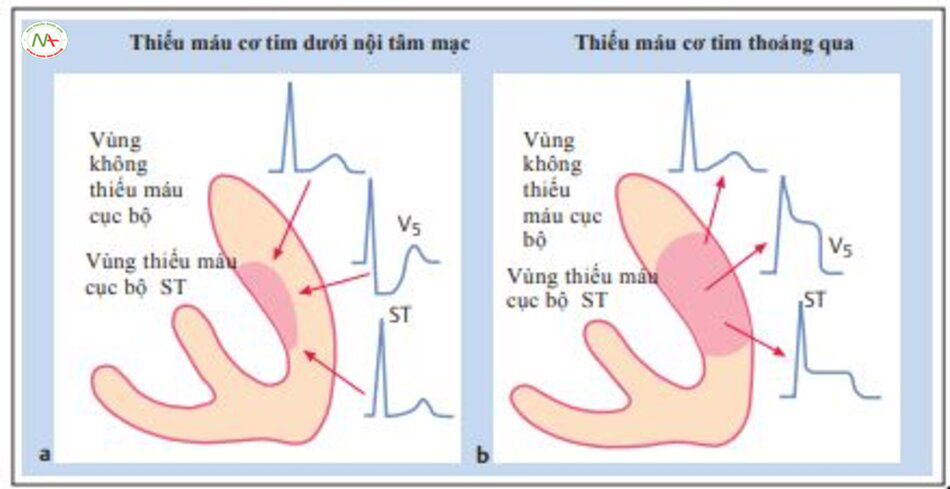 Hình 6.11 Các thay đổi trên ECG trong thiếu máu cục bộ dưới nội tâm mạc và thoáng qua. a,Trong thiếu máu cục bộ dưới nội tâm mạc ST chênh xuống, vì vector ST (mũi tên) hướng vào thành tâm thất. Các chuyển đạo ECG đặt trên vùng thiếu máu cục bộ cho thấy đoạn ST chênh xuống. b, Trong thiếu máu cục bộ thoáng qua, vector ST ST (mũi tên) hướng ra ngoài thành. Các chuyển đạo ECG đặt trên vùng thiếu máu cục bộ cho thấy đoạn ST chênh lên.