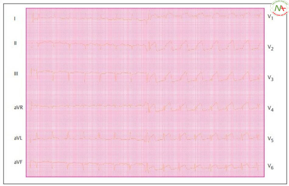 Hình 6.14 Nhồi máu cơ tim trước cấp thứ phát với tắc nghẽn nhánh động mạch liên thất trước (LAD) trên bệnh nhân 70 tuổi. ECG cho thấy đoạn ST chênh lên ở chuyển đạo V1 đến V6. V1 đến V6: chuyển đạo thành ngực theo Wilson.