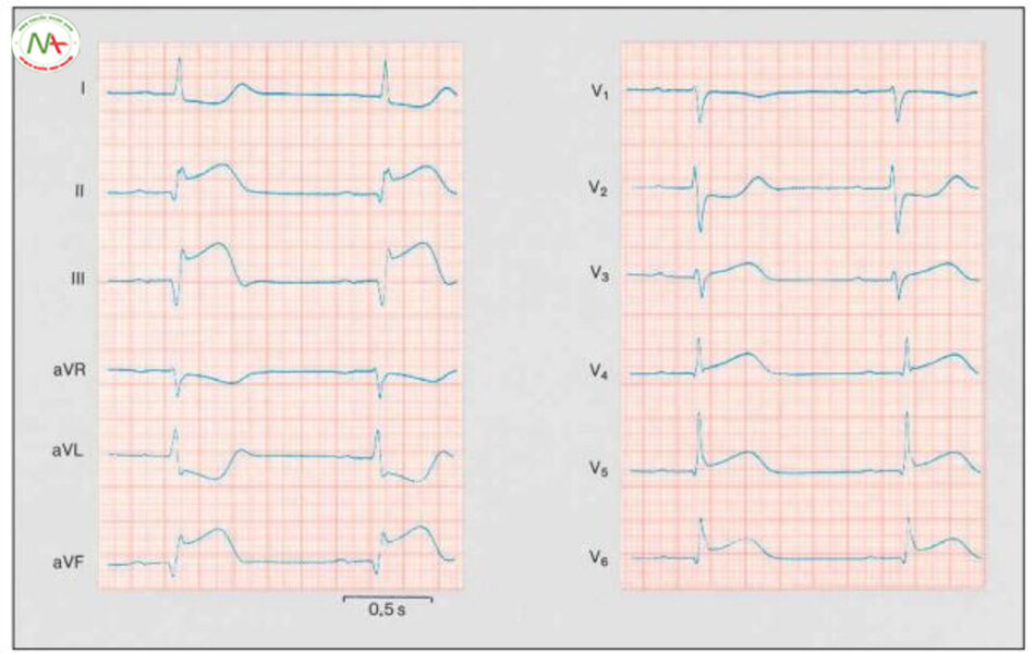 Hình 6.16 Bệnh nhân 49 tuổi sau 2 năm nhồi máu cơ tim trước vách. Chú ý điển hình là mất sóng R, đoạn ST chênh lên nhẹ và sóng T âm trong các chuyển đạo trước tim. Bệnh nhân 51 tuổi, 1 năm trước bị nhồi máu cơ tim sau dưới. Có thể thấy sóng Q điển hình trên các chuyển đạo II, III và aVF.