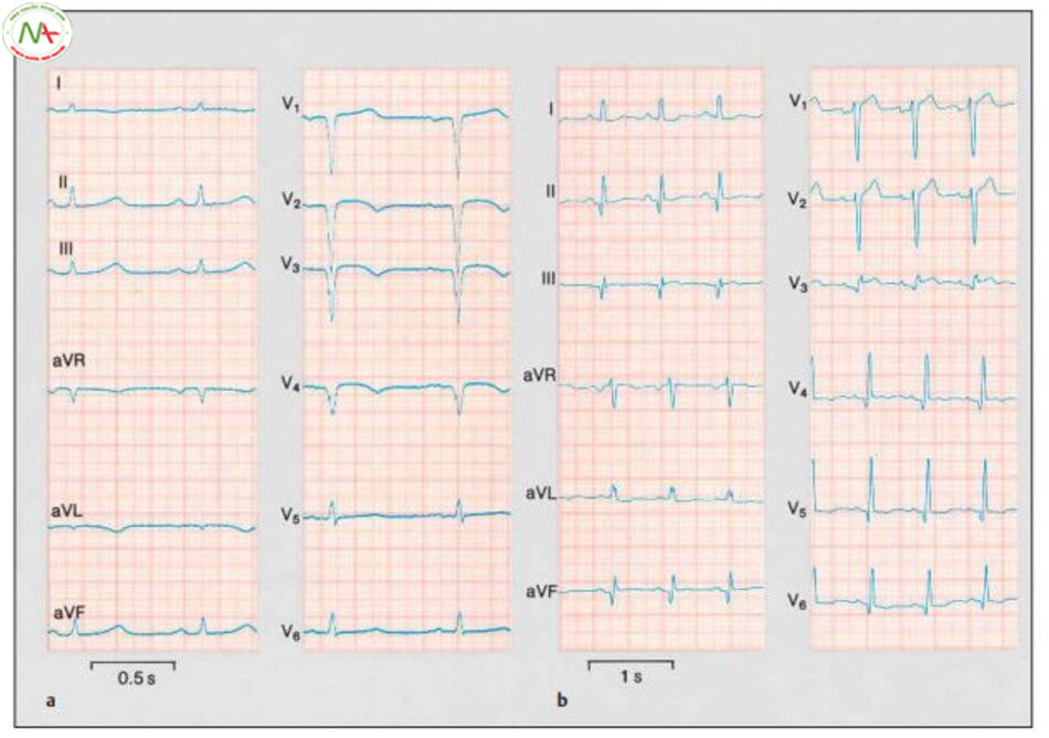 Hình 6.15 Nhồi máu cơ tim trước cấp trên bệnh nhân 80 tuổi. Trong các chuyển đạo II, III và aVF đoạn ST chênh lên điển hình và trong các chuyển đạo I và aVL xuất hiện đoạn ST chênh xuống đảo ngược. V1 đến V6: chuyển đạo thành ngực theo Wilson.