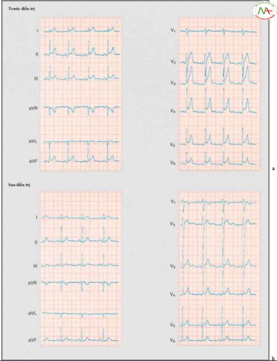 Hình 18 Những thay đổi trên ECG trong viêm màng ngoài tim cấp trên bệnh nhân 27 tuổi. a ECG trước khi tiến hành điều trị b b ECG sau 10 ngày điều trị bằng steroid. Đoạn ST chênh lên, xuất hiện trong tất cả chuyển đạo trước điều trị đã không còn thấy nữa. V1 đến V6: chuyển đạo thành ngực theo Wilson. 