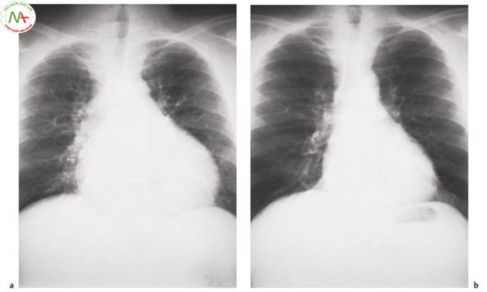 Hình 6.19 Xquang ngực trên bệnh nhân 47 tuổi bị tràn dịch màng tim 500ml sau nhồi máu cơ tim Trước khi chọc màng ngoài tim, bóng tim lớn và hình quả lê b Sau khi chọc màng ngoài tim, bóng tim bình thường