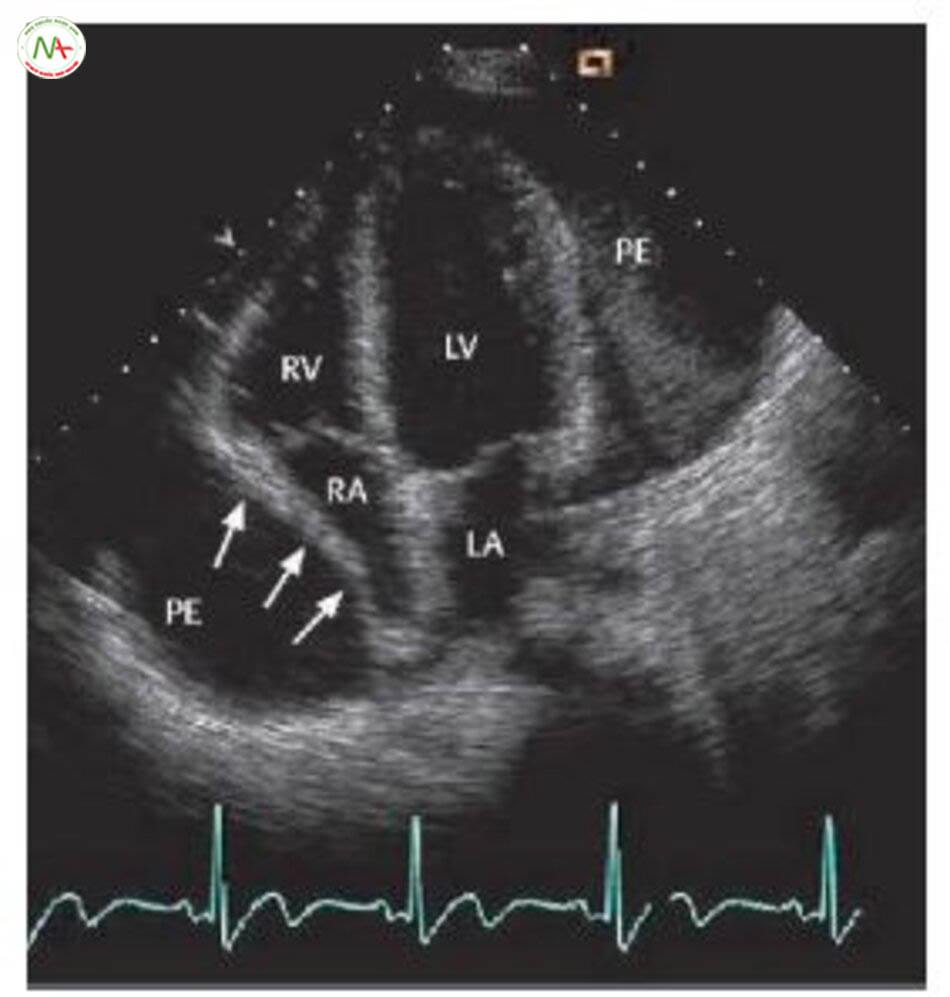 Hình 6.20 Siêu âm tim trên bệnh nhân tràn dịch màng tim mạn. Hình ảnh đỉnh 4 buồng tim cho thấy tràn dịch màng tim (PE) chu vi lớn, tim trong tình trạng “bập bềnh”. Chèn ép nhĩ phải (RA, mũi tên) là dấu hiệu chèn ép tim. LV=thất trái, RV = thất phải, LA = nhĩ trái.