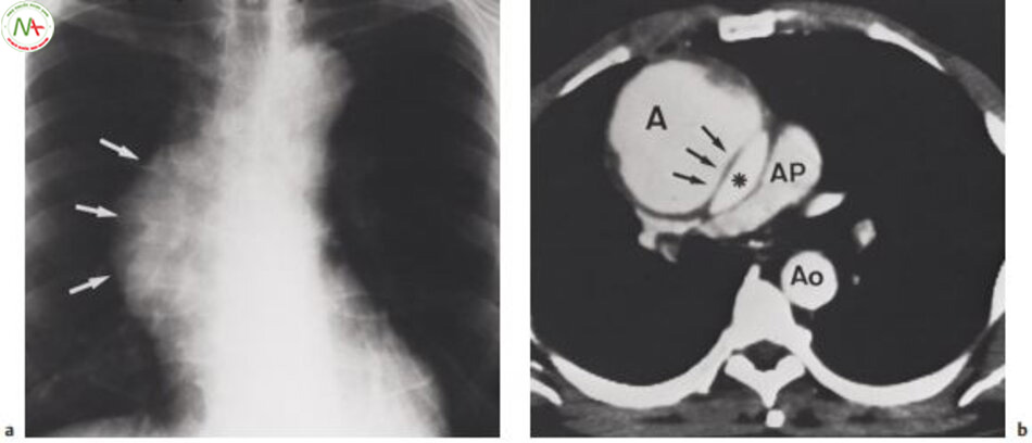 Hình 6.21 Bóc tách đoạn lên động mạch chủ (loại A) trên bệnh nhân 57 tuổi. Thấy rõ giãn dị thường đoạn lên động mạch chủ (mũi tên) Chụp cắt lớp vi tính trên bệnh nhân này cho thấy phình mạch và màng bóc tách (mũi tên). A=phình mạch, AP=động mạch phổi, Ao=đoạn xuống động mạch chủ,*= chỗ đúng của đoạn lên động mạch chủ 