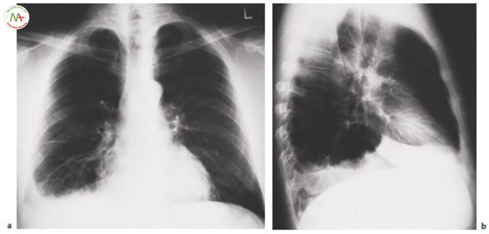 Hình 6.22 Xquang ngực điển hình tràn dịch màng phổi phải Hình sau trước Hình bên