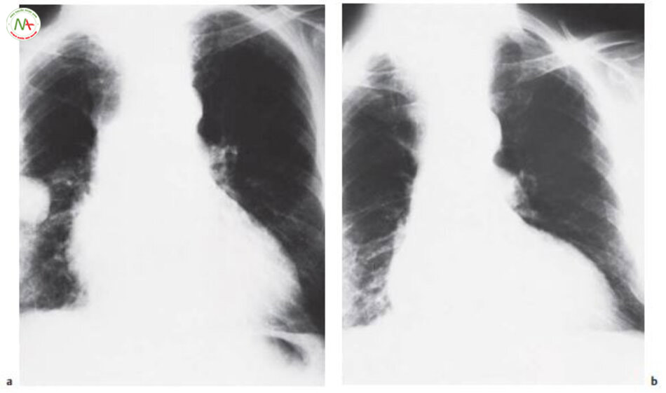 Hình 6.23 Tràn dịch gian thùy trong suy tim sung huyếta Trước điều trị. b Sau điều trị bằng lợi tiểu: “u biến mất”