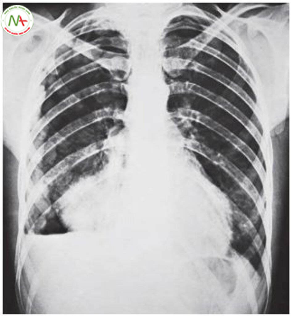 Hình 6.24 Đặc trưng nhưng hiếm gặp, biểu hiện u trung biểu mô di căn với nhiều nốt dày màng phổi. Tế bào học trong dịch màng phổi: nhiều lần âm tính với tế bào u di căn.