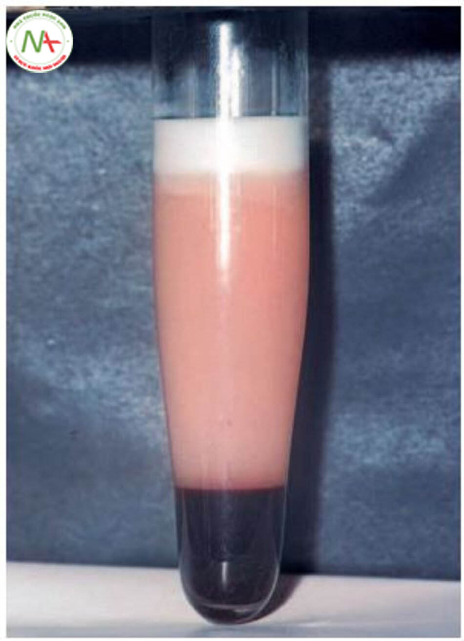 Hình 6.4 Tăng chylomicron máu dạng “kem” trên huyết thanh (hyperchymomicronemia)