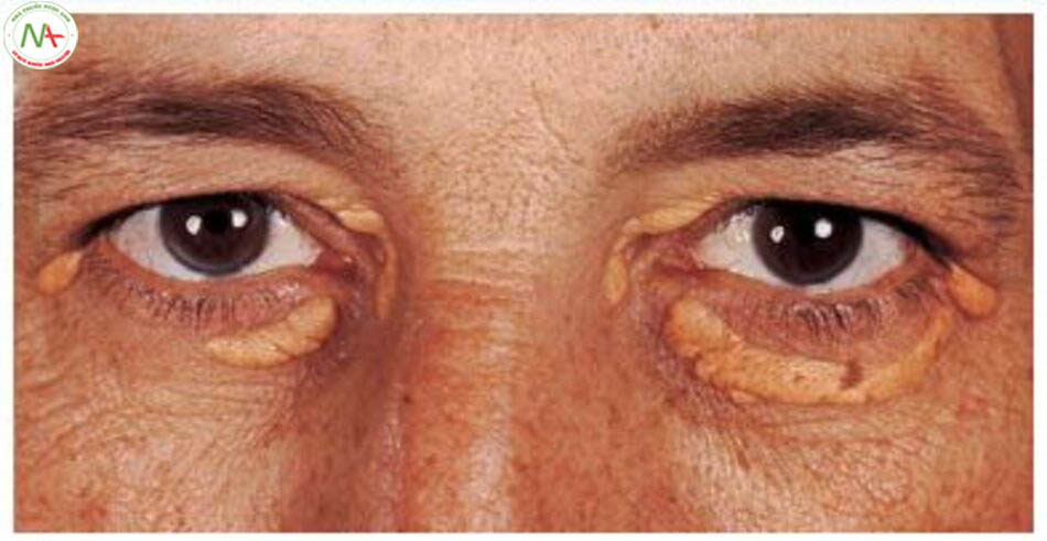 Hình 6.5 U mỡ kết mạc và ban vàng mi mắt trên bệnh nhân 43 tuổi tăng cholesterol máu.