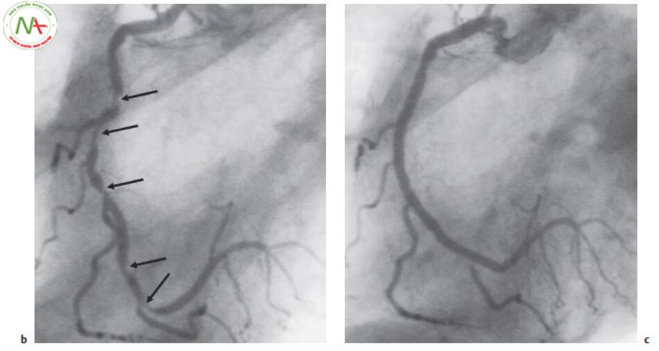 Hình 6.9 b. Chụp động mạch vành cho thấy động mạch vành phải, phân thành nhiều nhánh nhỏ với hẹp đoạn gần và 2 chỗ hẹp nhiều hơn ở phần xa. c. Điều trị tắc nghẽn mạch vành thành công nhờ can thiệp mạch vành qua da và đặt stent.