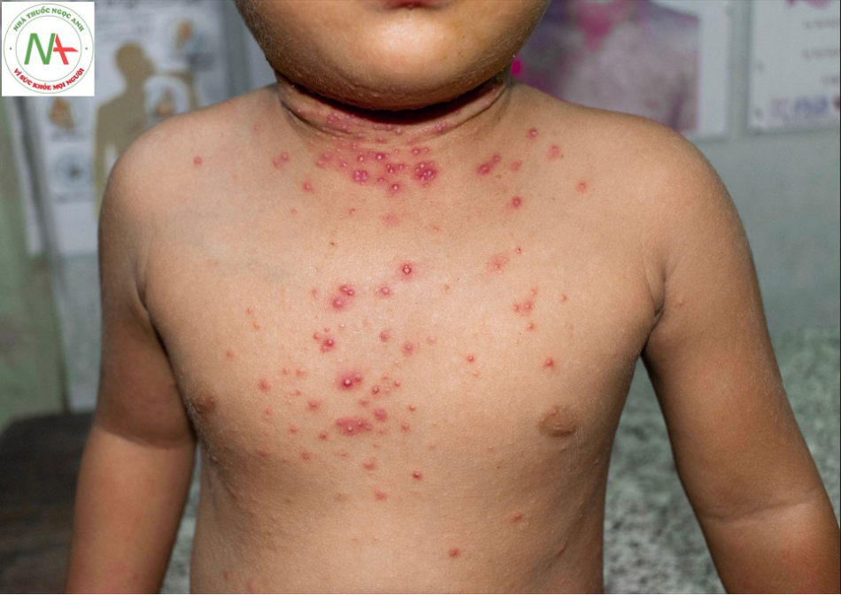 Bệnh đậu mùa khỉ (Monkeypox))