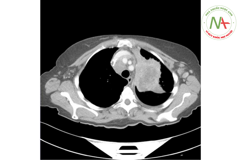CT scan của ngực bệnh nhân