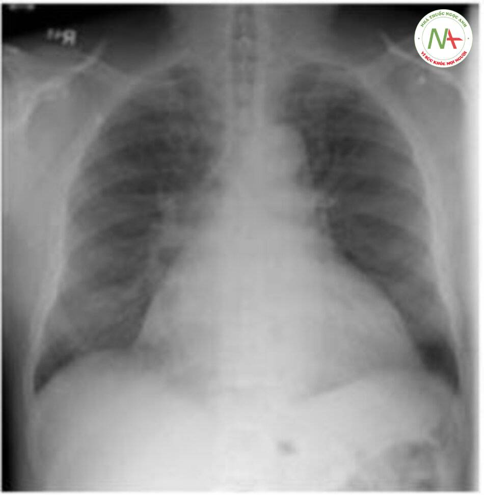 Hình 3 – 3 A: x quang ngực với bóng tim to ở bệnh nhân tràn dịch màng ngoài tim