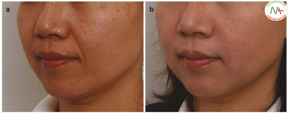 Hình 4.81 (a) Trước và (b) sau khi điều trị các nếp gấp mũi - miệng tĩnh sâu.