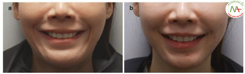 Hình 4.82 (a) Trước và (b) sau khi điều trị nếp gấp mũi - miệng động bằng kỹ thuật tiêm kiểu dương xỉ.