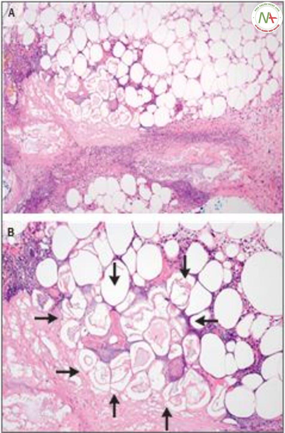 Hình 3. Mẫu da sinh thiết. Nhuộm Hematoxylin và eosin thấy thùy viêm mô mỡ dưới da ảnh hưởng đến mô dưới da (A), với hoại tử chất béo và xà phòng hóa, đặc trưng bởi các tế bào mỡ ưa bazo và không nhân (B, mũi tên).