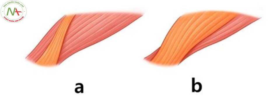 Hình 4. Cơ cau mày có bụng chéo (màu cam) và bụng ngang (màu đỏ). Bụng chéo có hai loại: loại hẹp (a) và loại rộng (b).