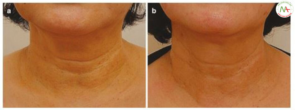 Hình 4.131 (a) Trước và (b) sau khi điều trị nếp nhăn cổ ngang bằng chất làm đầy HA.