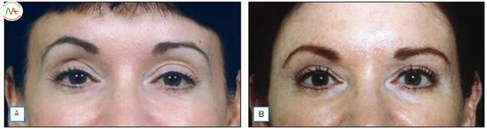 Hình 17.5 A, Một bệnh nhân 68 tuổi với hốc mắt hõm B, 3 năm sau khi được tiêm 1ml HA vào mỗi bên mắt.