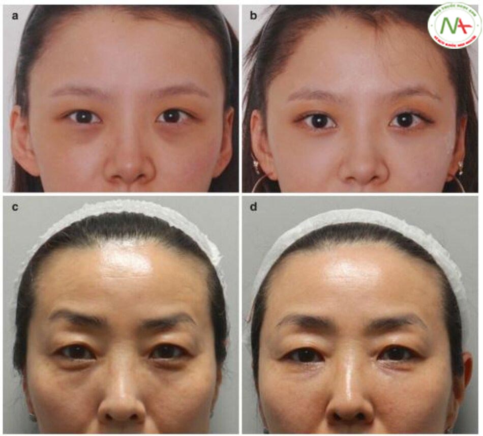 Hình 4.33 (a) Trước và (b) sau khi tăng thể tích rãnh lệ ở một phụ nữ 28 tuổi. (c) Trước và (d) sau khi tăng thể tích rãnh lệ, rãnh mí mắt má và má trước sụt xuống ở một phụ nữ 48 tuổi.
