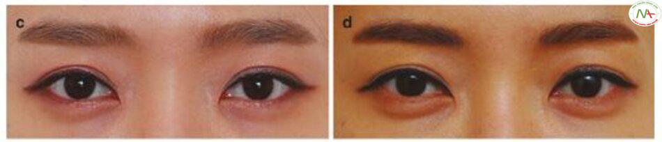 Hình 4.26 Tiếp theo (c) Trước và (d) sau khi bơm bọng mắt với chất làm đầy HA kết hợp với việc nâng mắt trũng và hõm dưới ổ mắt.
