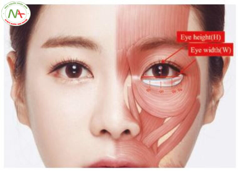 Hình 4.28 Độ dày hấp dẫn của một bọng mắt so với chiều rộng và chiều cao của khe mắt, dựa trên các phép đo được thực hiện từ 10 sao nữ Hàn Quốc có khuôn mặt thon đẹp tự nhiên bao gồm Tae Hee Kim, Young-Ae Lee, Hye-Kyo Song, v.v., là bằng 30% chiều rộng và 65% chiều cao khe mắt.