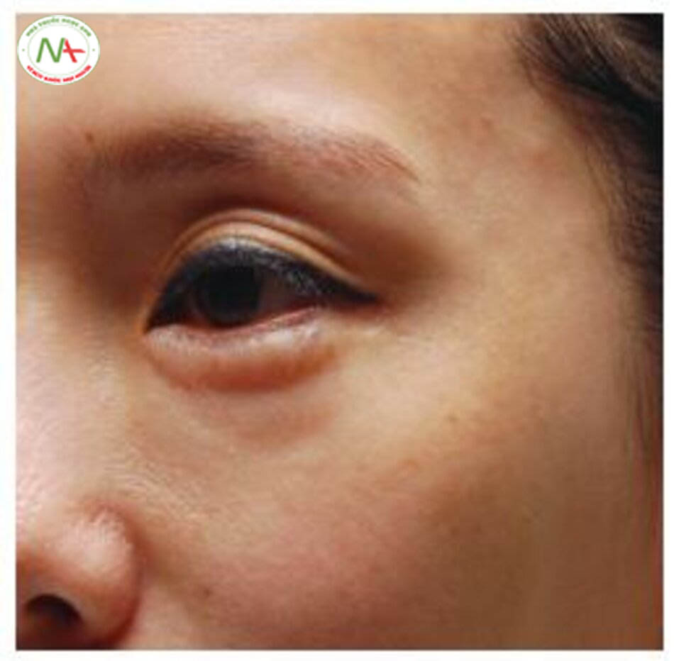 Hình 4.29 Đường viền không đều do nâng bọng mắt ở một phụ nữ 45 tuổi với sự kết dính mô sẹo hình thành ở mi dưới do tiền sử phẫu thuật tạo hình mí mắt dưới.