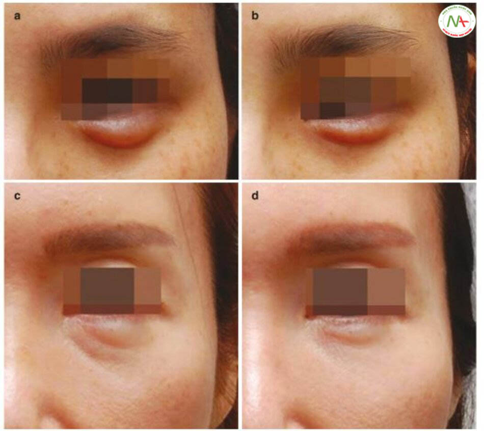Hình 4.31 (a) Một bọng mắt quá dày. (b) Sau khi giảm một phần bằng cách tiêm hyaluronidase. (c) Biến dạng vón cục sau khi nâng bọng mắt. (d) Sau khi giảm một phần bằng cách tiêm hyaluronidase.