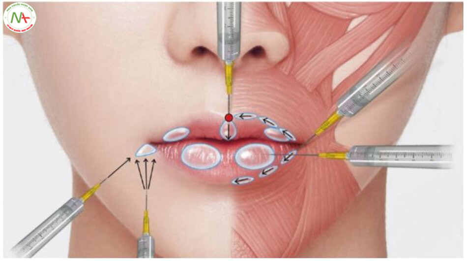 Hình 4.96 Kỹ thuật tiêm để nâng môi bằng kim (môi trái) và nâng khóe miệng (khóe miệng phải).