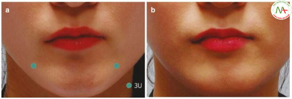 Hình. 4.97 (a) Trước và (b) sau khi tiêm độc tố Botulinum 3U mỗi bên trong cơ hạ góc miệng (DAO) để nâng góc miệng.