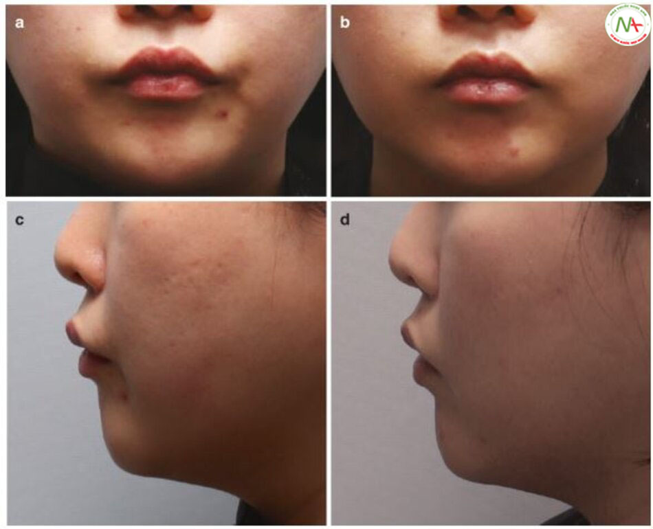 Hình 4.98 (a, c) Trước và (b, d) sau khi tiêm hyaluronidase vào môi trên để điều trị “môi vịt” do tiêm quá nhiều.