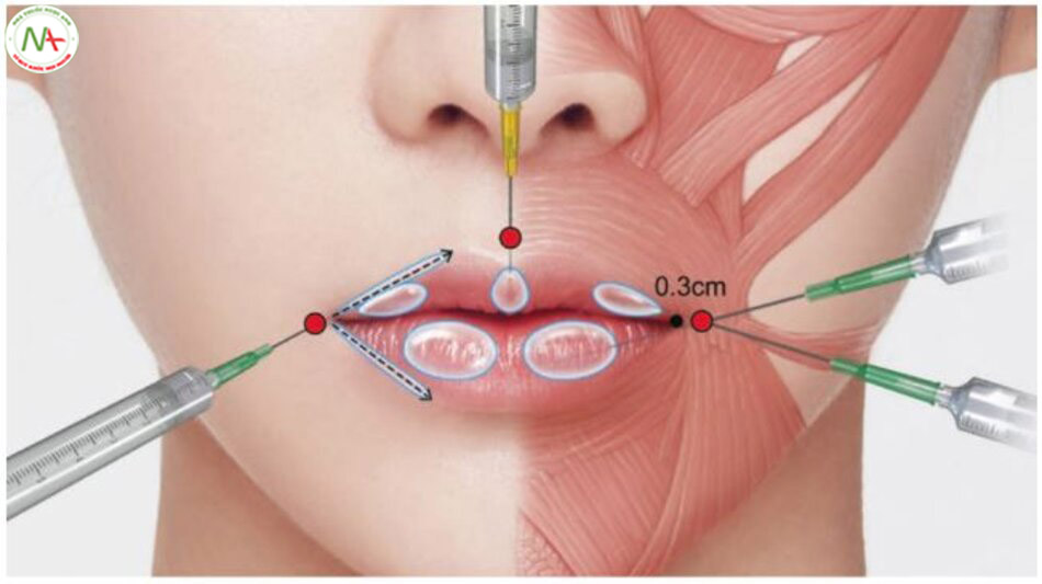 Hình 4.95 Kỹ thuật tiêm để nâng môi bằng ống thông.
