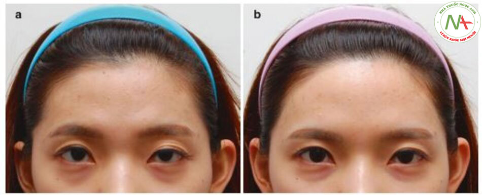 Hình 4.21 Tiêm độc tố botulinum để lthư giãn cơ trán ở một bệnh nhân 26 tuổi bị chứng sa mí mắt có thể cải thiện tình trạng mắt trũng. (a) Trước và (b) sau khi tiêm.
