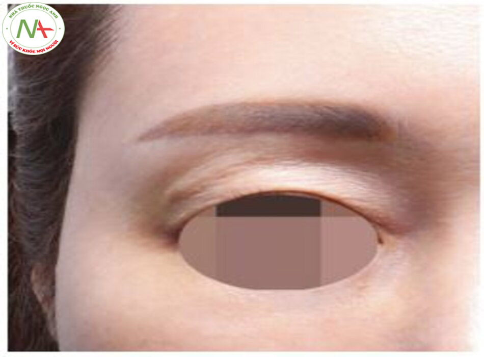 Hình 4.24 Đường viền không đều của mí mắt trên sau khi nâng mắt trũng bằng HA.