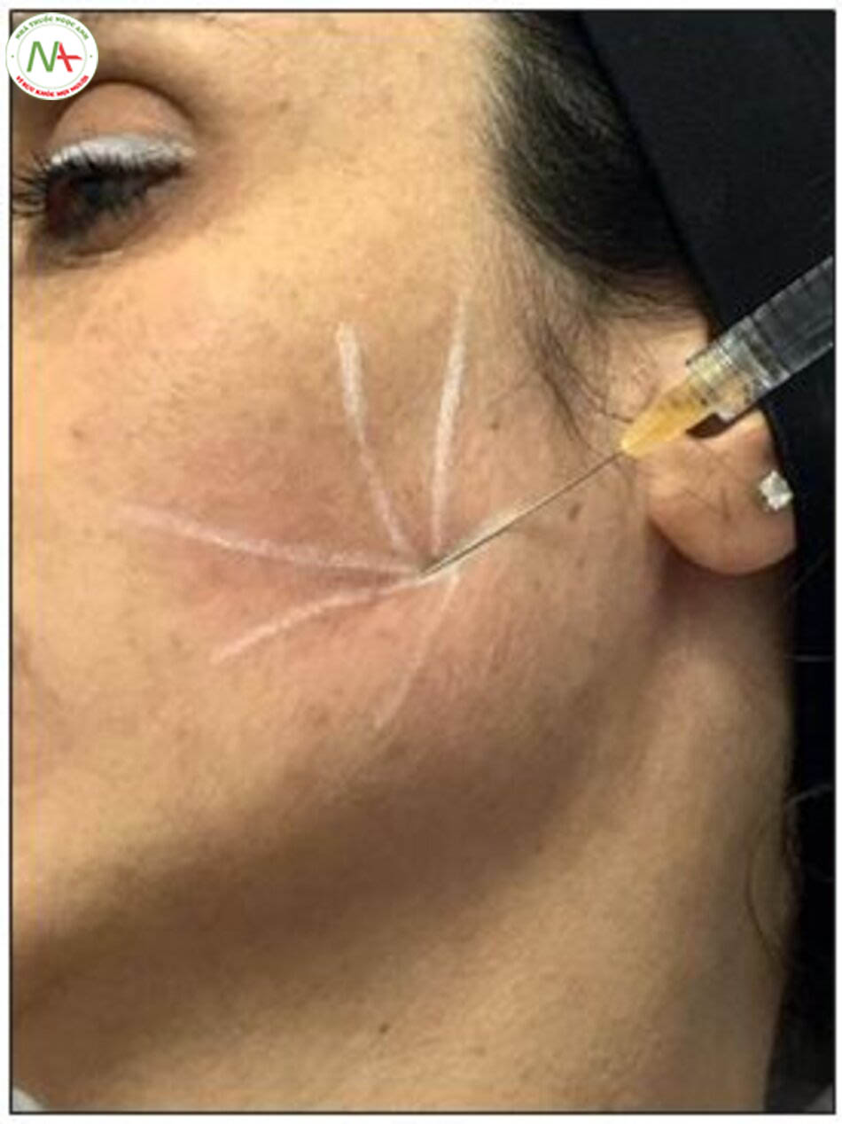 Figure 19.11 The HA filler is deposited in a fanning technique, forming a “star,” that helps to lift the lateral midface (star lift).