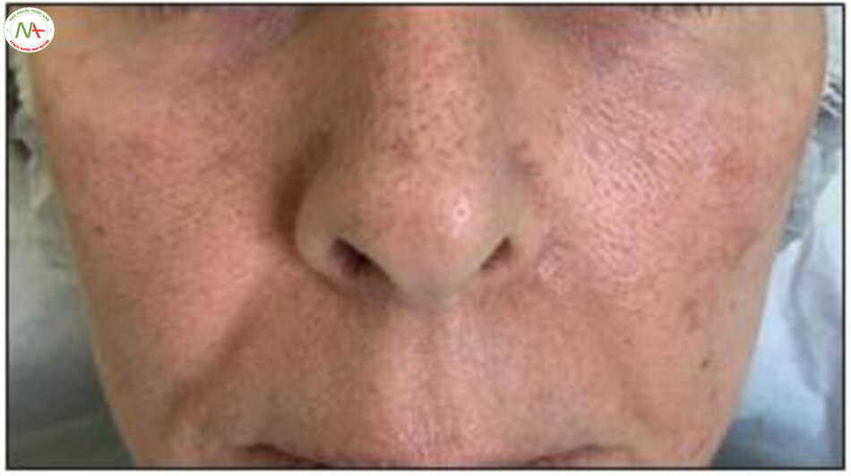 Figure 19.9 Only left cheek was treated showing improvement of left lid–cheek junction and left nasolabial fold, compared with untreated right side.