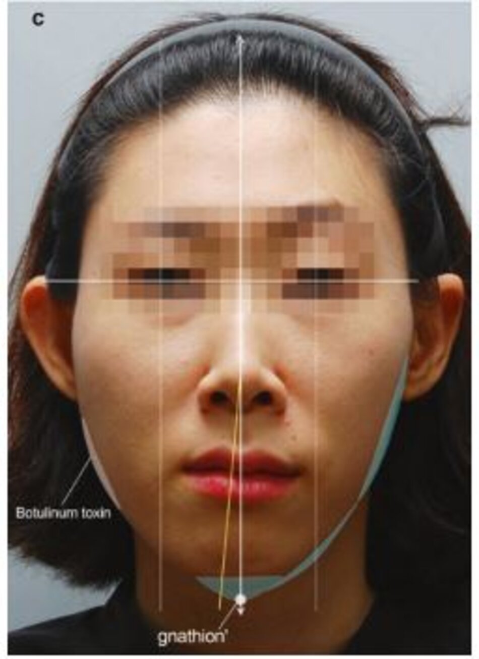 Hình 4.126 Đánh giá trước điều trị về sự bất đối xứng trên khuôn mặt ((a) Trước, (b) sau khi điều trị bằng cách sử dụng chất làm đầy và độc tố botulinum và (c) chiến lược đánh giá và điều trị cho sự bất đối xứng trên khuôn mặt).